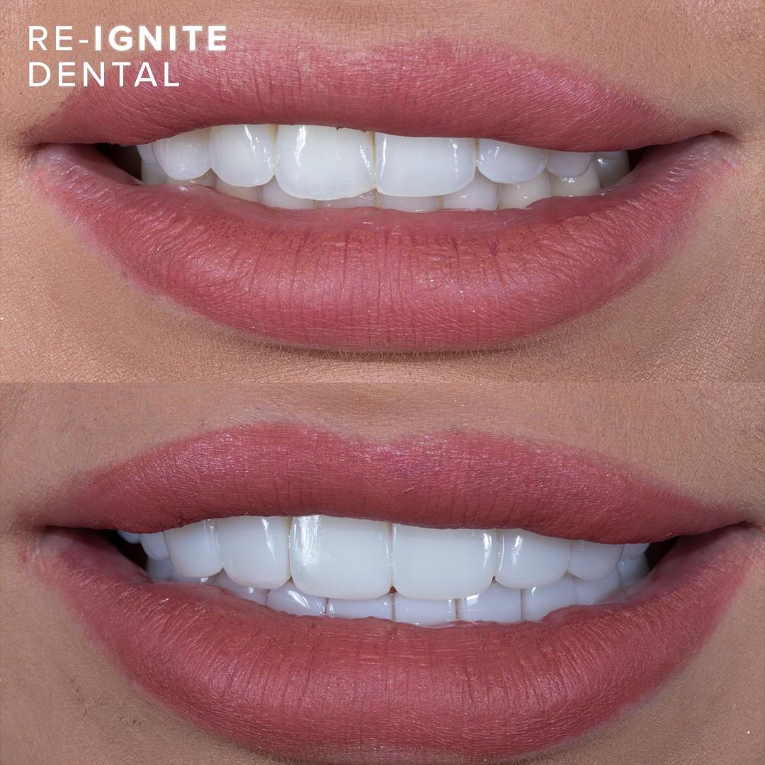 Composite bonding before and after — patient case 3, Re-Ignite Dental