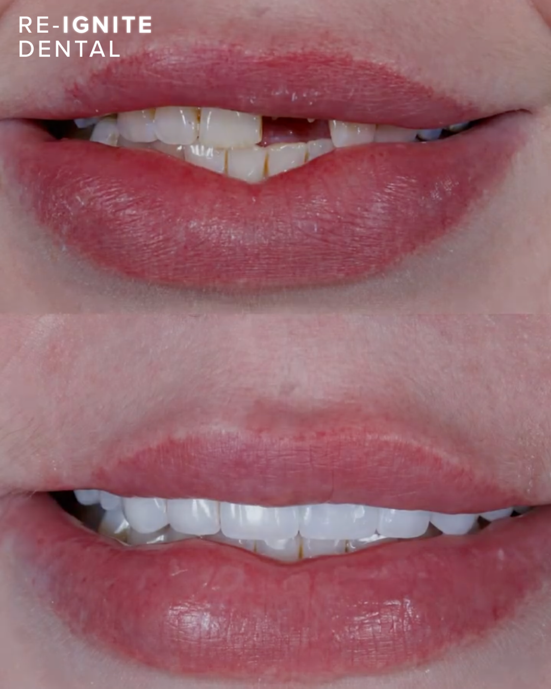 Dental implant rehabilitation before and after — patient case 2, Re-Ignite Dental
