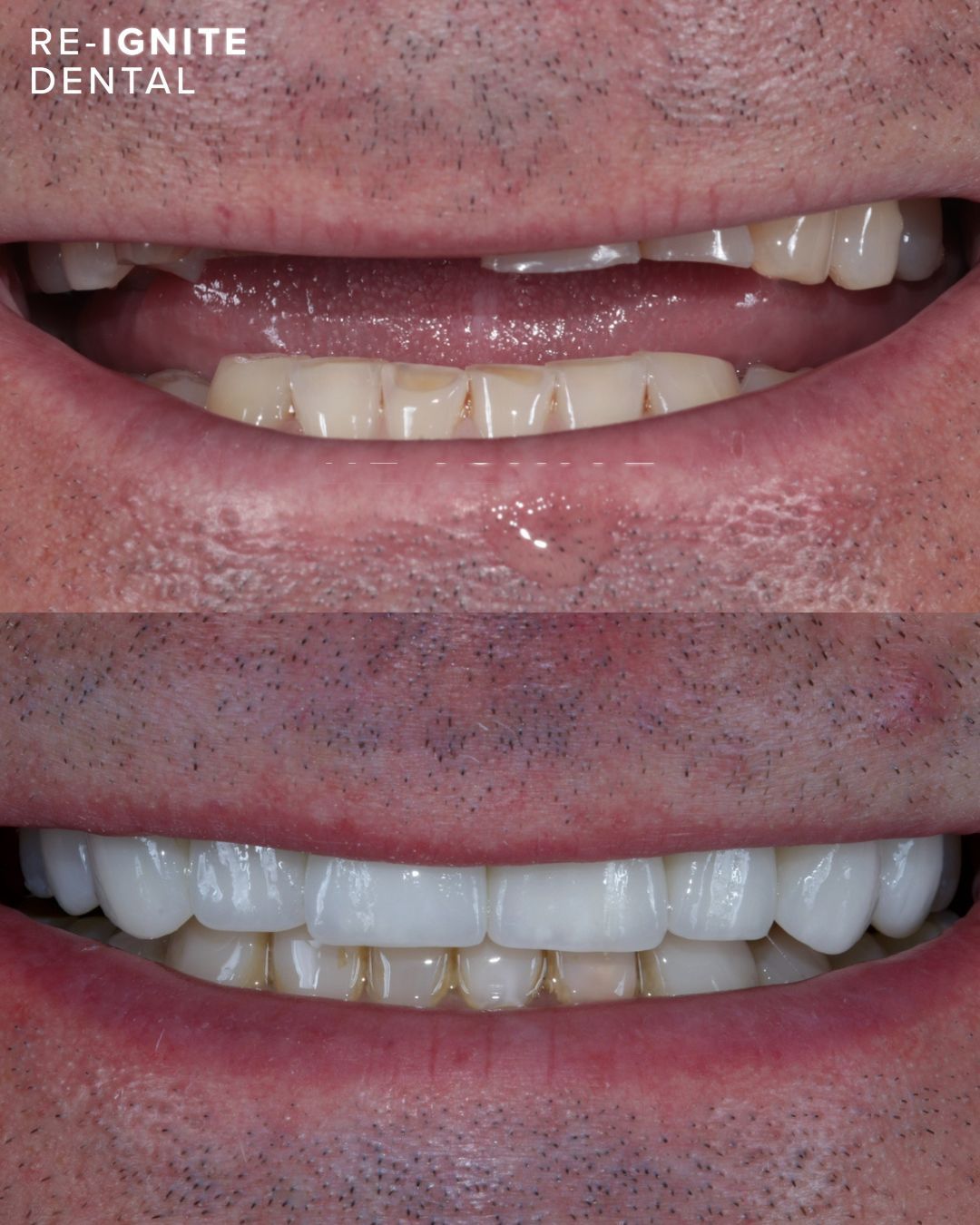 Dental implant rehabilitation before and after — patient case 1, Re-Ignite Dental