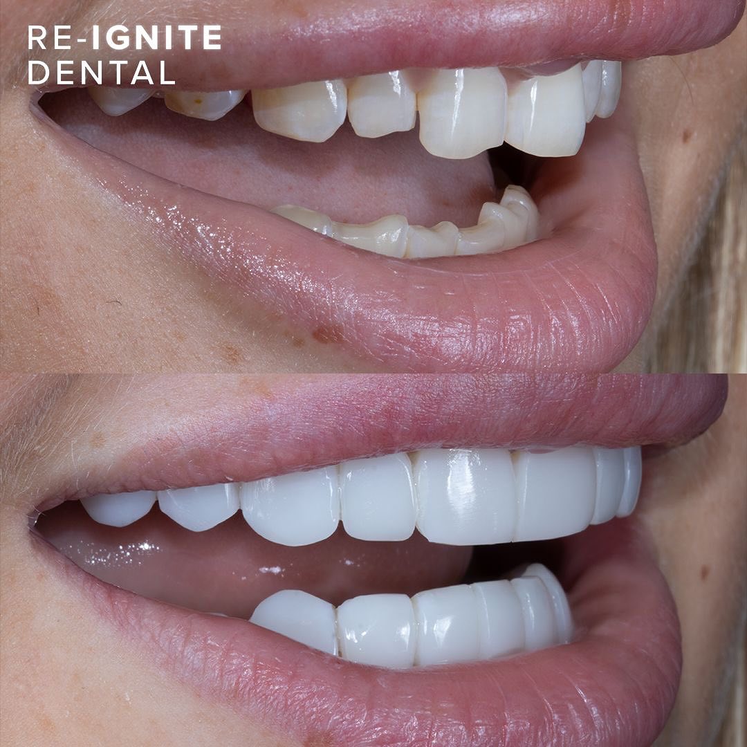 Composite bonding before and after — patient case 1, Re-Ignite Dental