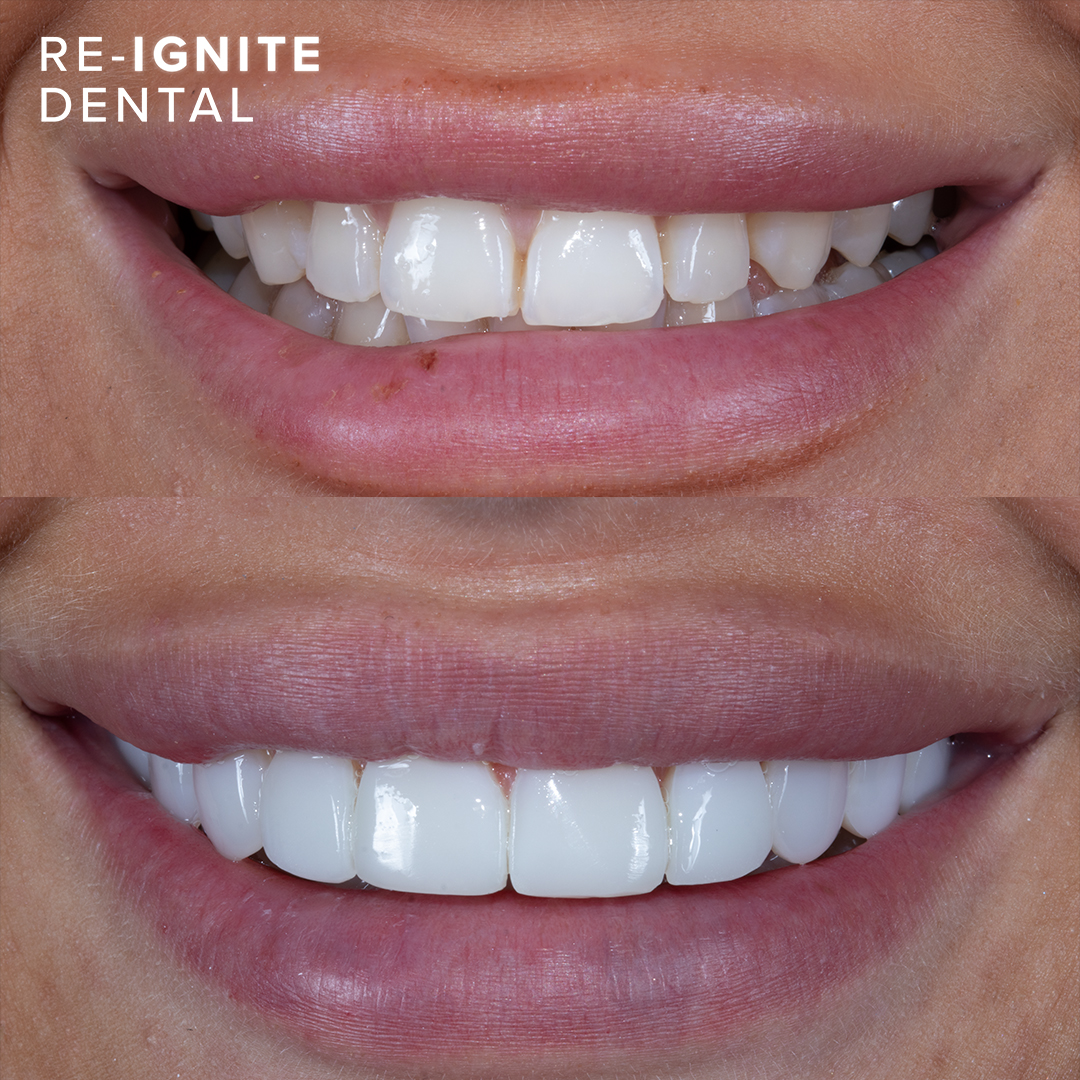 Composite bonding before and after — patient case 6, Re-Ignite Dental