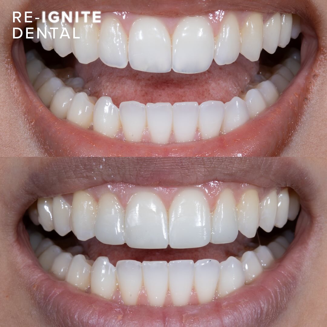 Composite bonding before and after — patient case 2, Re-Ignite Dental
