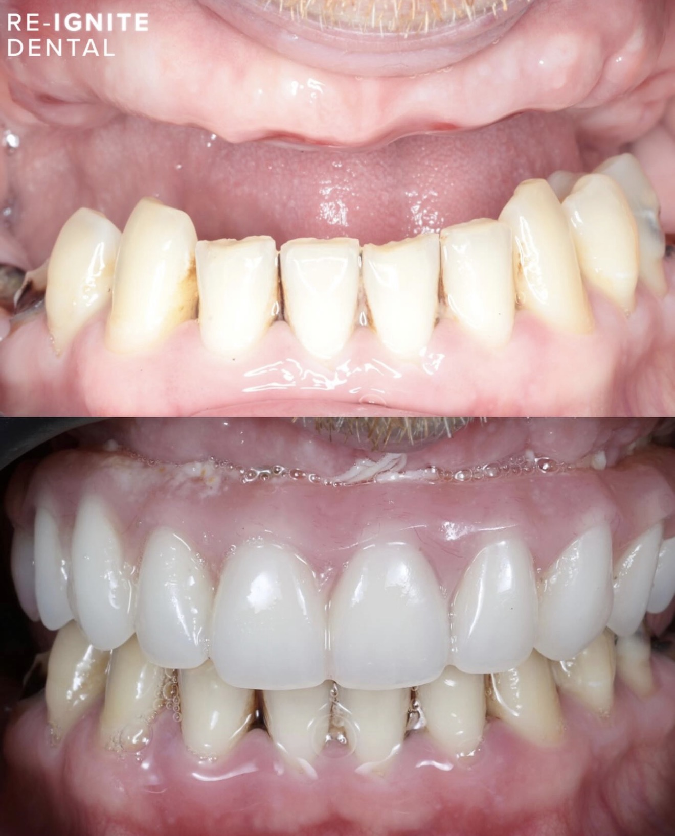 Full-arch dental implant rehabilitation before and after — patient case 3, Re-Ignite Dental