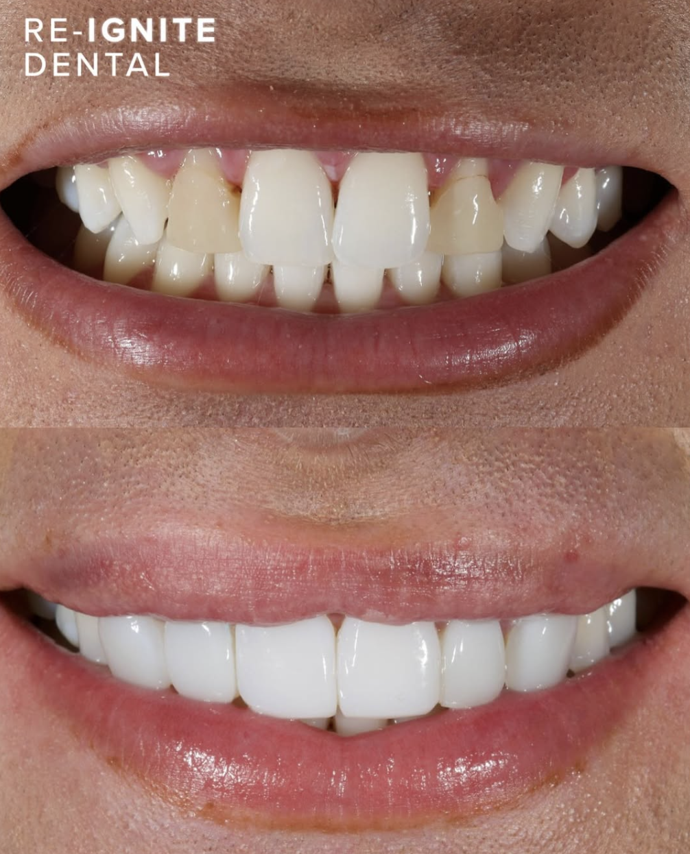 Composite bonding before and after — patient case 7, Re-Ignite Dental