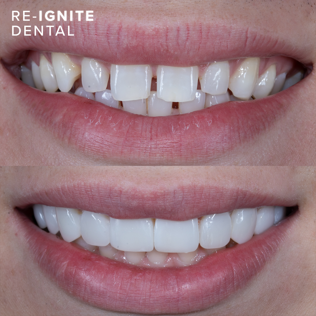 Composite bonding before and after — patient case 5, Re-Ignite Dental