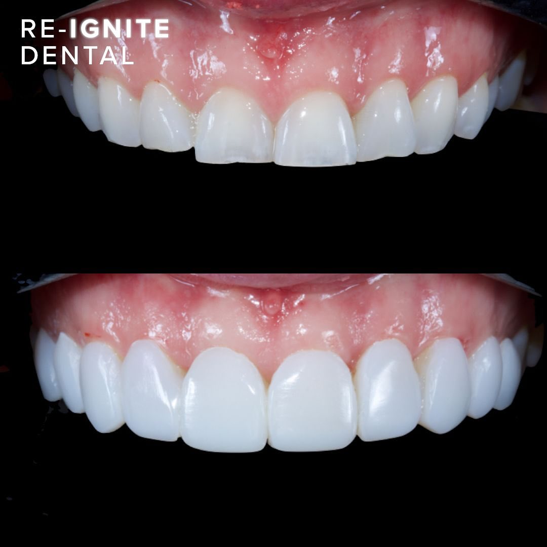 Composite bonding before and after — patient case 4, Re-Ignite Dental